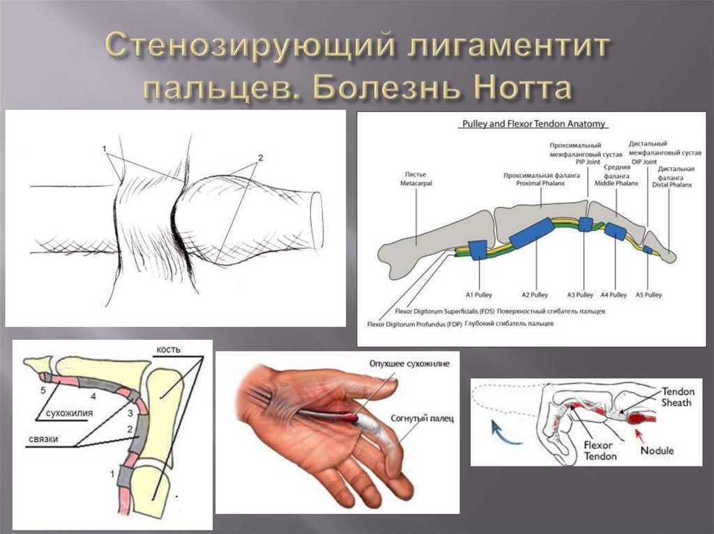 Синдром щелкающего пальца - kinesiopro