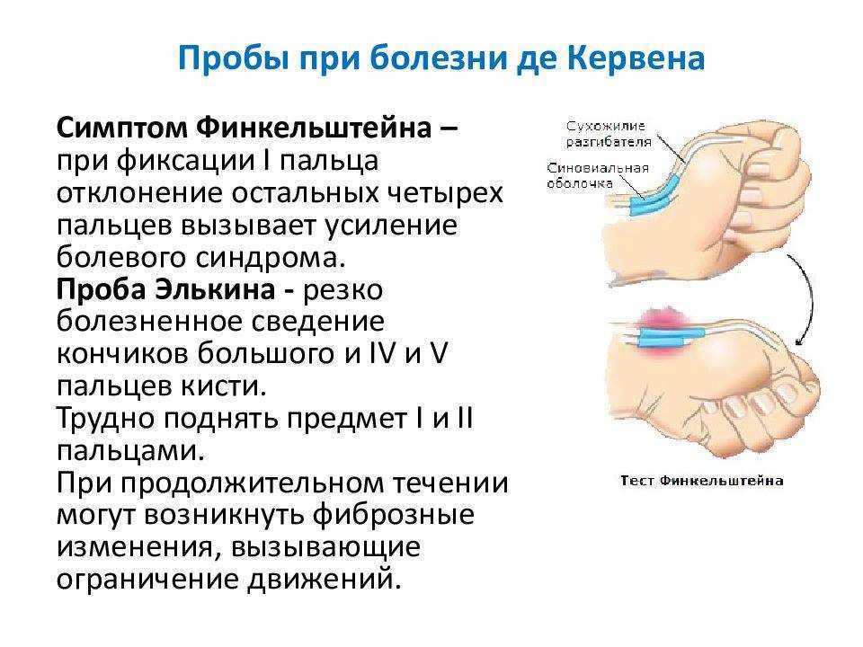 Симптом де кервена. Болезнь де Кервена лучезапястного сустава. Тендовагинит де Кервена кисти. Болезнь де Кервена большого пальца. Болезнь де Кервена. Стенозирующий тендовагинит.