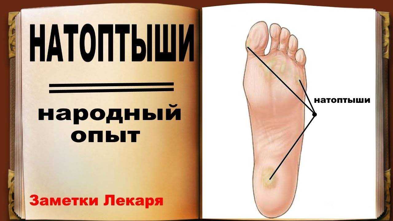 Удаление натоптышей на ногах в центре подологии podolab