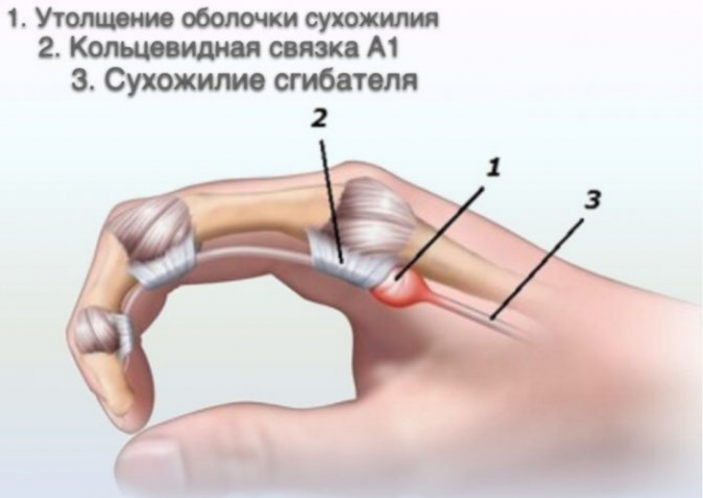 Щелкающий палец (стенозирующий лингаментит) лечение, операция | щелкает сустав пальца