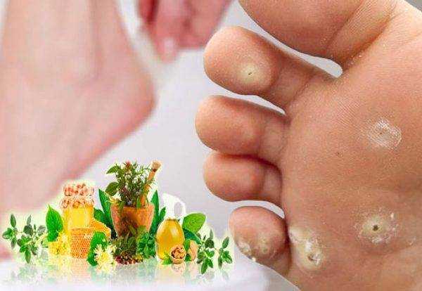 Мозоли. их лечение и удаление.