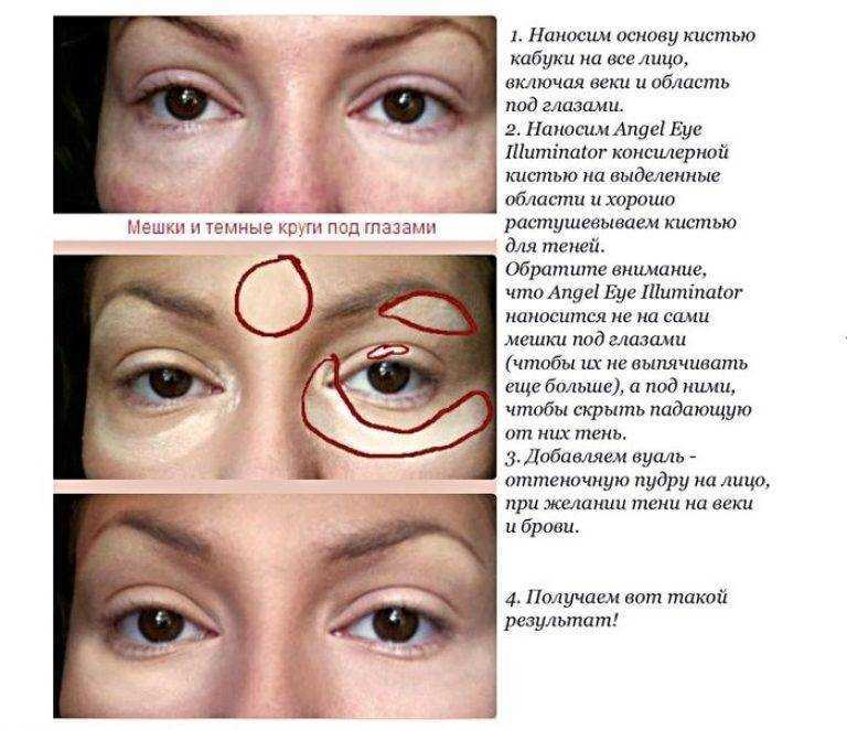 Ушибы и гематомы. помощь при ушибах, средства от гематом