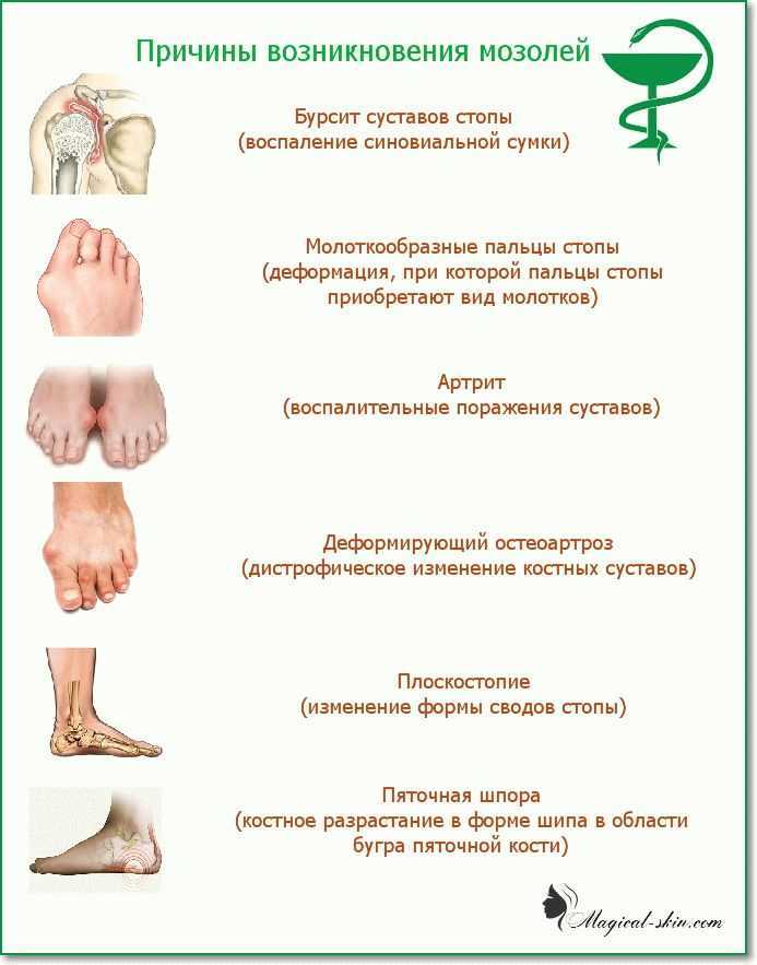 Чем лечить натертый обувью мозоль. Сухая мозоль сбоку стопы. Появление мозолей на стопе.